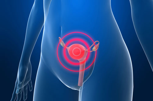 MATERIAL GRÁFICO DE CÁNCER DE CUELLO DE ÚTERO